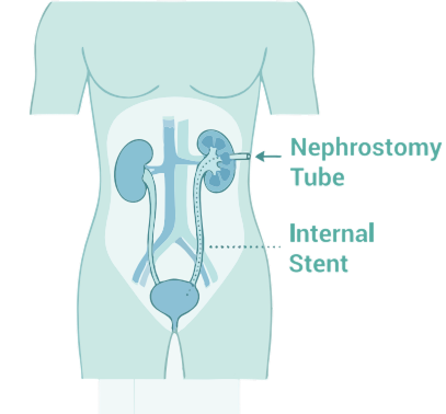 Understanding nephrostomy tube and internal stent